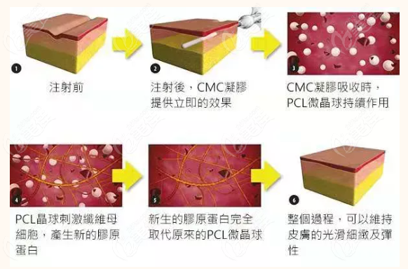 伊妍仕少女针填充鼻子怎么样打完会出现红肿的副作用吗