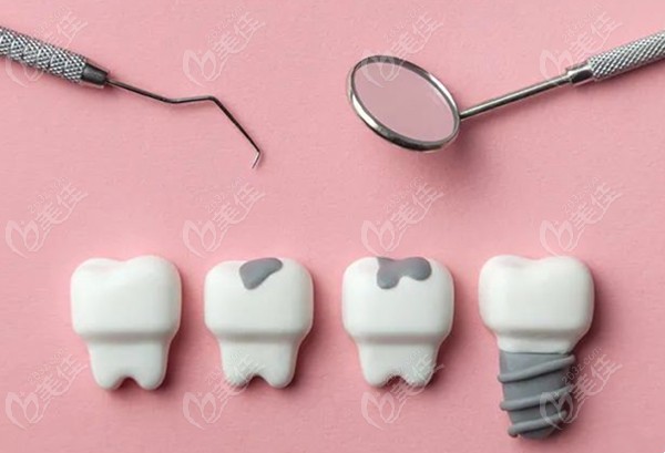 全口种植牙的常用修复方式