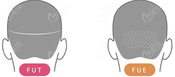 fue和fut植发术后后枕部的区别