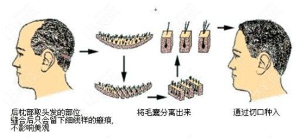 FUT隐痕植发的过程