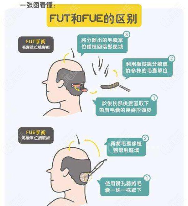 FUT隐痕植发与FUE植发的区别图