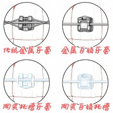 自锁托槽锁开了可以自己整吗