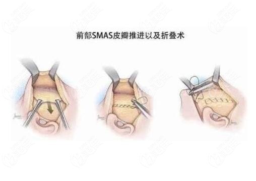 筋膜折叠术多久能恢复正常