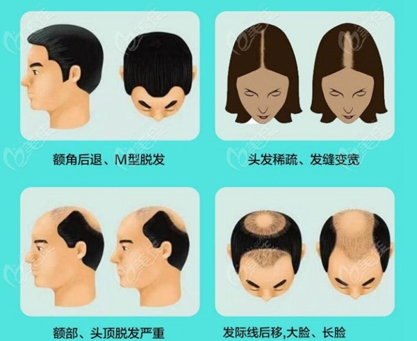 头发有这些问题的可以选择植发来解决呦