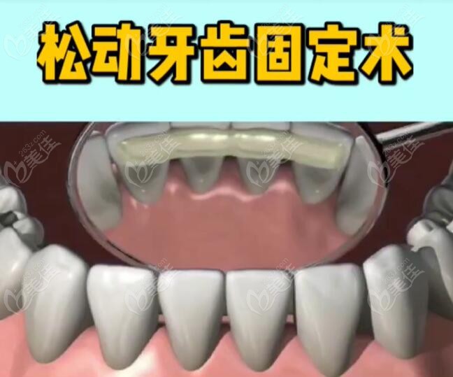 牙齿松动固定术