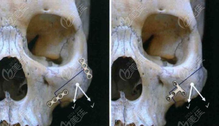 顴骨內(nèi)推正確固定方法 顴骨內(nèi)推正確固定方法