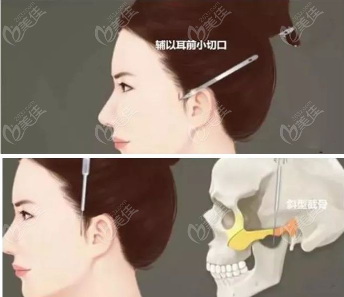 顴骨內(nèi)推的手術(shù)過程決定是否兩年后臉下垂 顴骨內(nèi)推的手術(shù)過程決定是否兩年后臉下垂