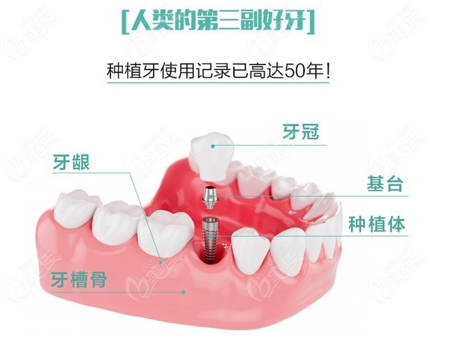 杨浦区种植牙一颗多少钱