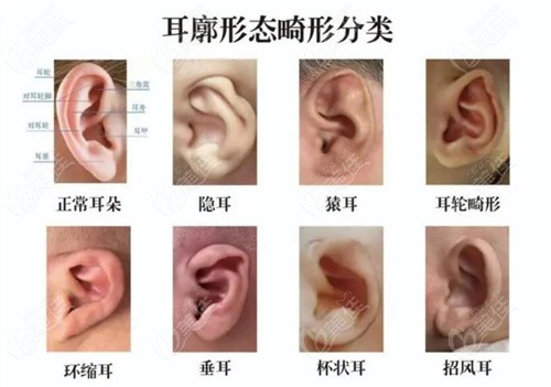各种耳朵畸形问题