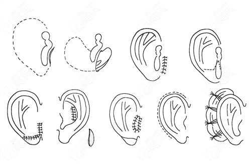 全耳再造的过程