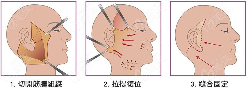 男士额头拉皮做一次多少钱呢？
