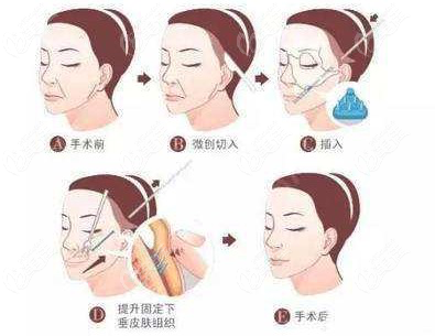 风筝拉皮手术是什么呢？