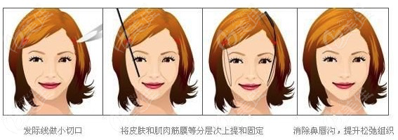 风筝拉皮手术过程展示图
