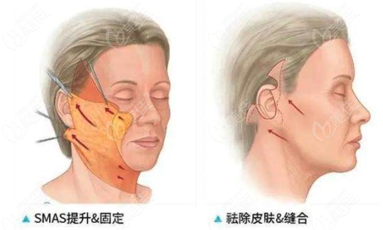 风筝拉皮手术能够维持多久呢？
