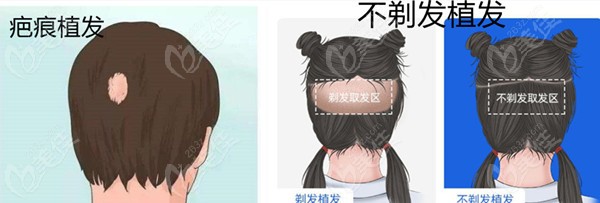 小疤痕植发、不剃发植发等会有开台费