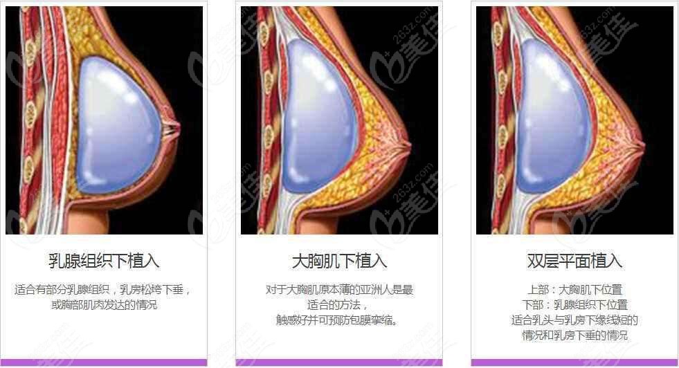 原因得从双平面隆胸的技术说起:双平面丰胸其实就是结合了胸大肌和