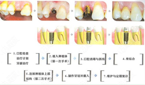 两段式种植牙的流程图