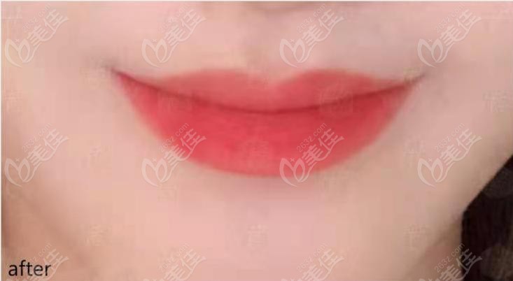 在韩国做的微笑唇疤痕太严重了怎么会?不信看我在韩国做的微笑唇照片