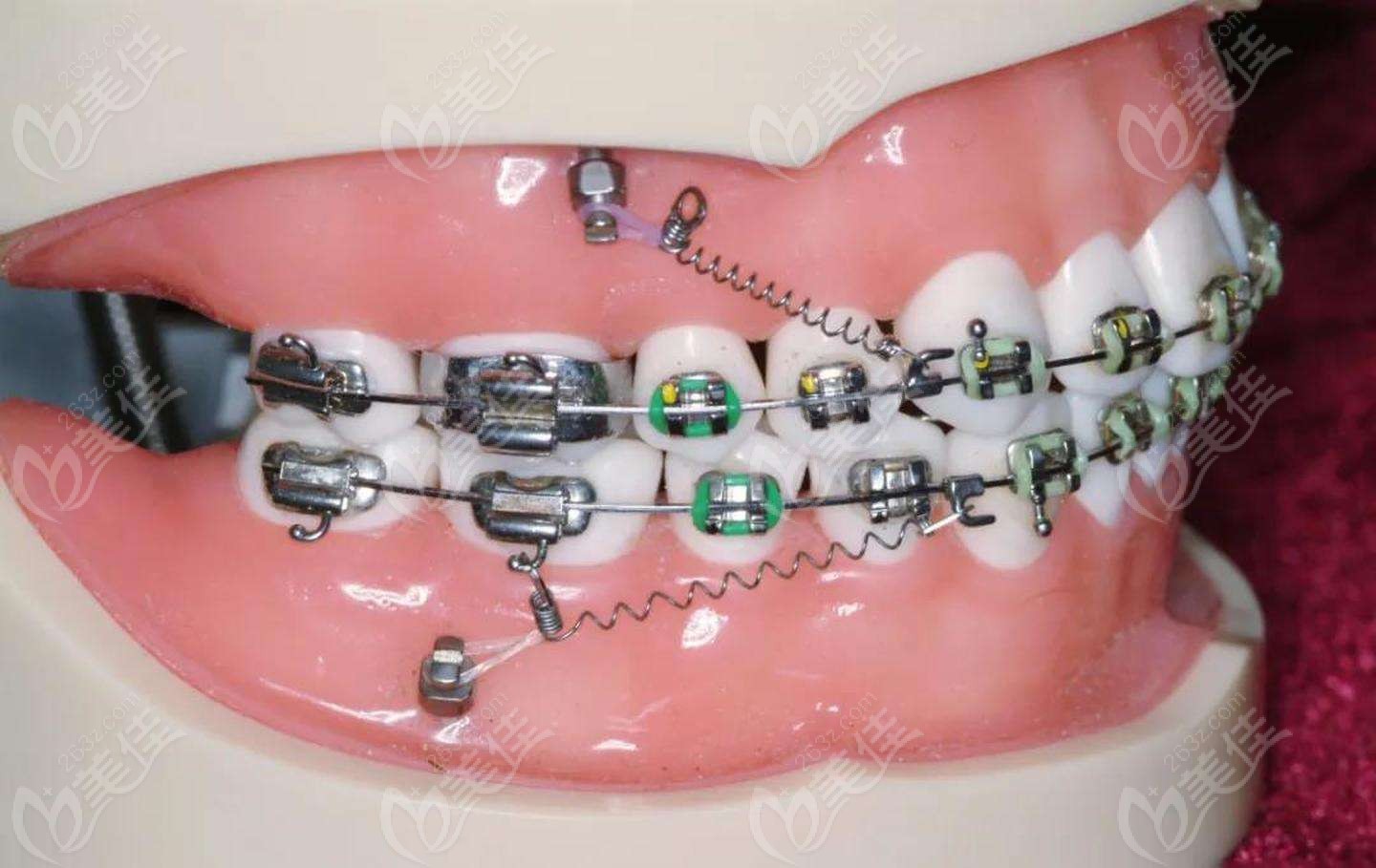 豫大口腔牙齿矫正器