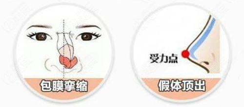武汉艺星鼻综合修复类型