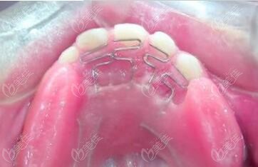 双曲舌簧颌垫矫治器图片