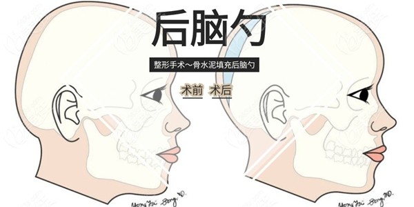 韩国雕刻整形外科后脑勺整形