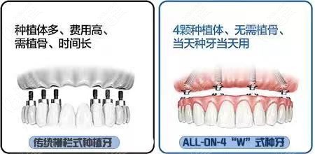 半口传统栅栏式种植牙和all-on-4种植牙优缺点对比