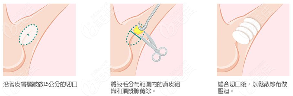 南昌市除腋臭到哪家医院好要做微创除狐臭手术好的