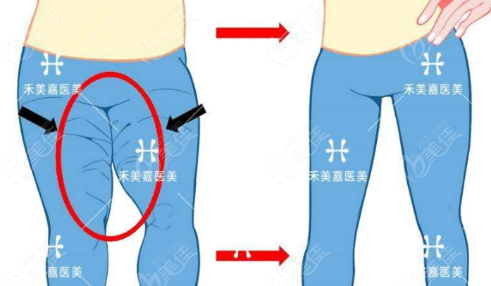 大腿吸脂大腿根能瘦嗎