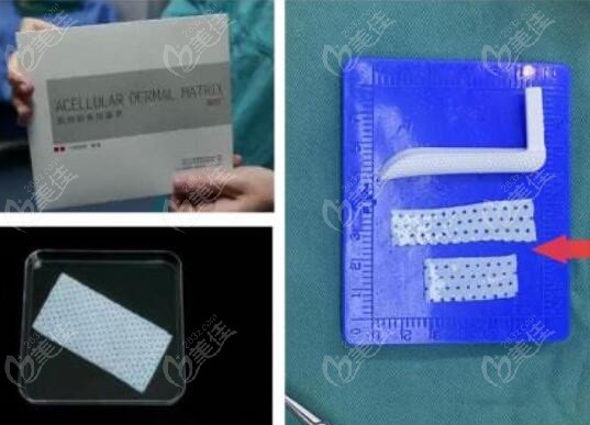 真质ADM鼻基底再生填充物