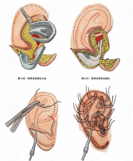 曼特波生物支架耳再造过程
