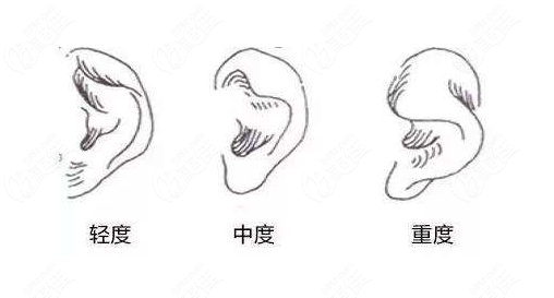 杯状耳矫正的后遗症有哪些