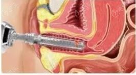 激光縮陰示意圖