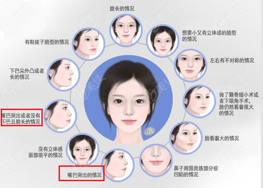 除了凸嘴正颌手术还能改善很多脸型问题