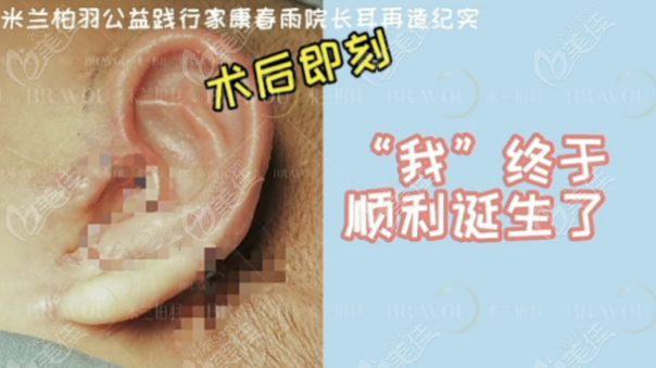 成都米兰柏羽整形医院康春雨医生做耳再造怎么样