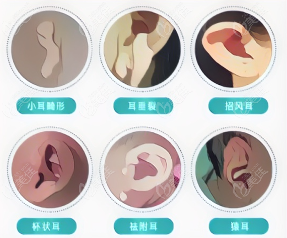 成都做小耳畸形再造手术哪家医院好
