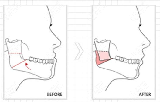 骨性凸嘴正颌手术后脸型变化前后对比图
