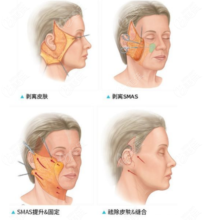 黄广香医生是广州做smas筋膜除皱术比较厉害的医生