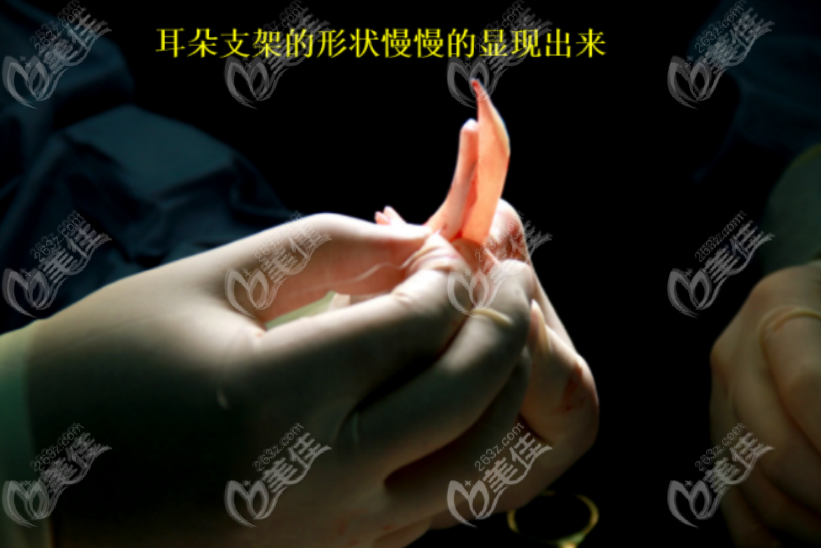 <!--<i data=20240703-sp></i>-->医生雕刻耳朵的样子