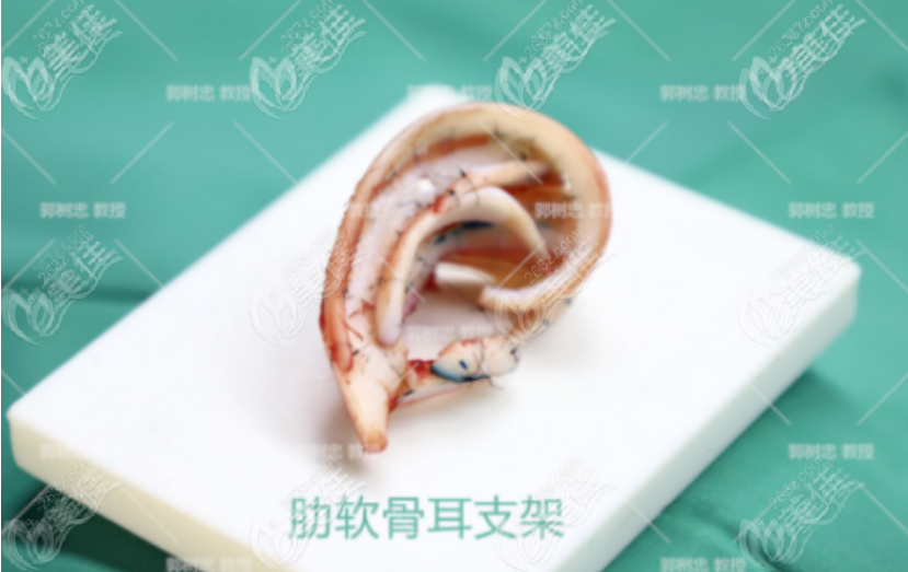 <!--<i data=20240703-sp></i>-->医生雕刻出来的耳朵支架