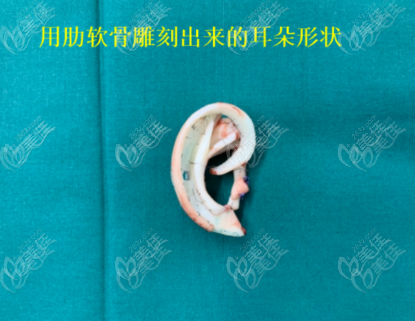 郭树忠医生雕刻出来的耳朵支架