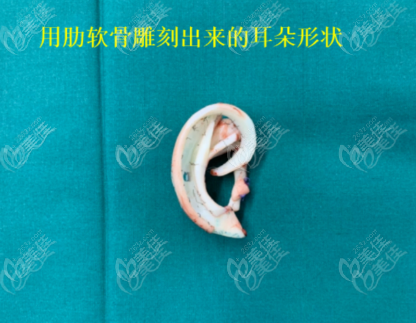 <!--<i data=20240703-sp></i>-->医生雕刻出来的耳朵支架