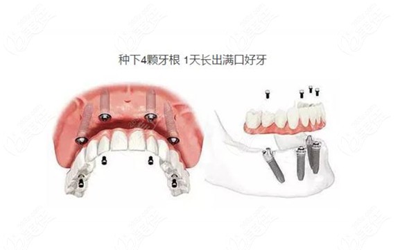 大连齿医生口腔种植牙优势展示