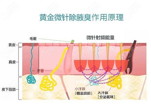 黃金微針40治療腋臭需要做幾次呢還有術後去除腋臭能維持幾年