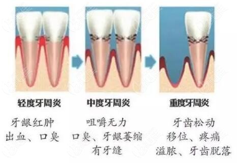 牙周炎的发展过程