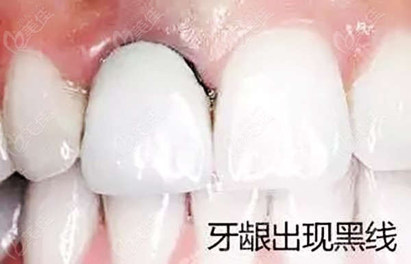 牙齿根管牙套图片