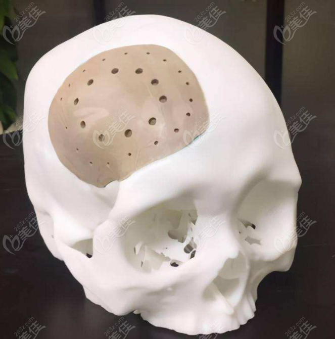 peek人工骨做颅骨