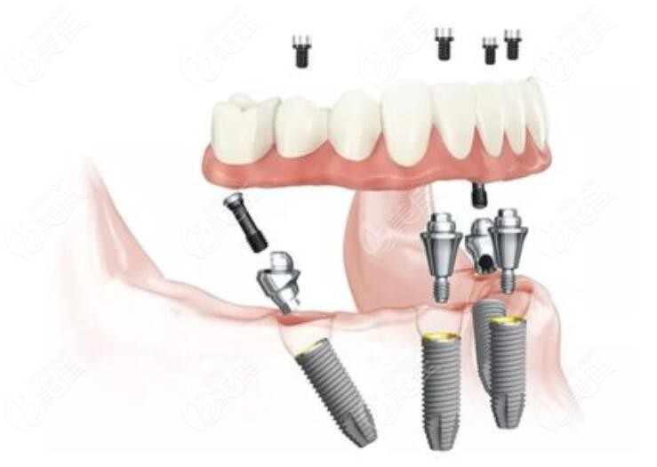 上4下4种植牙技术