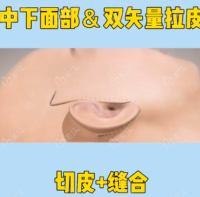  双矢量拉皮手术切开和缝合的样子