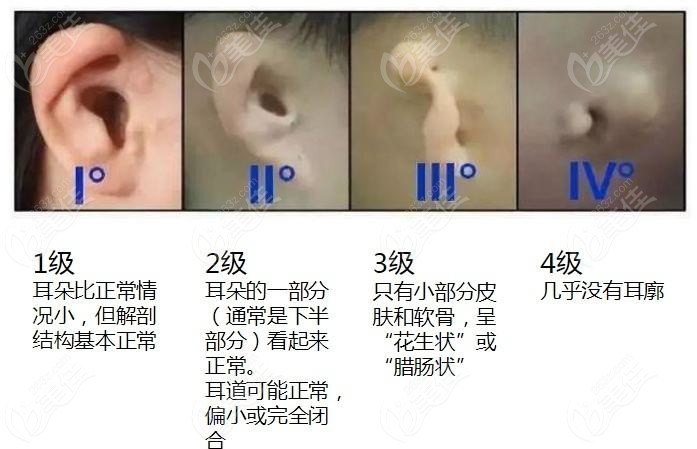 小耳畸形需要做耳再造手术矫正